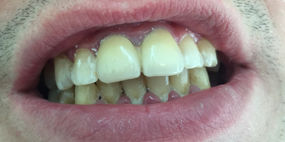  Установка металлокерамических коронок на два центральных зуба