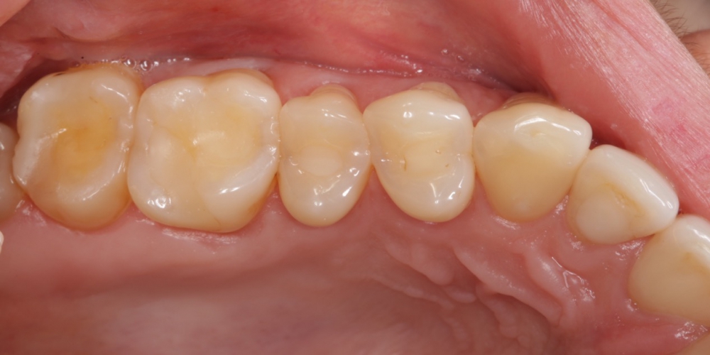  Реставрация жевательных зубов