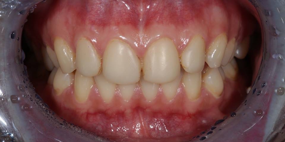  Реставрационное отбеливание зубов