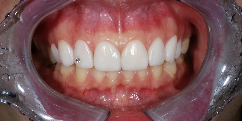  Реставрационное отбеливание зубов