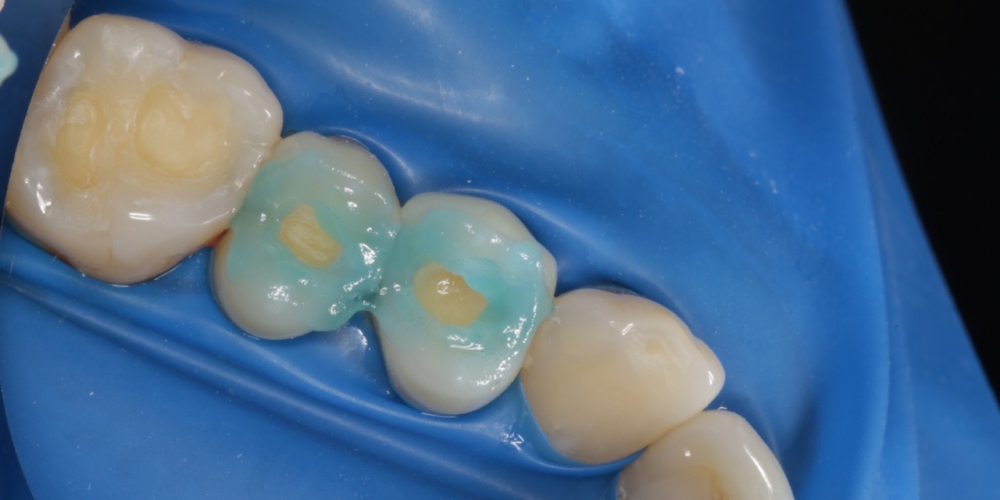  Реставрация жевательных зубов