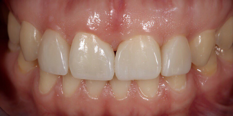  Закрытие диастемы и трем (щели) между зубами