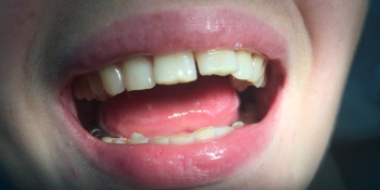 Установка металлокерамических коронок на 4 центральных зуба фото до лечения