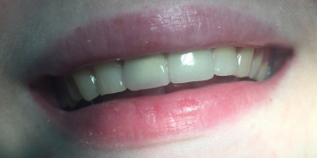 Установка металлокерамических коронок на 4 центральных зуба фото после лечения