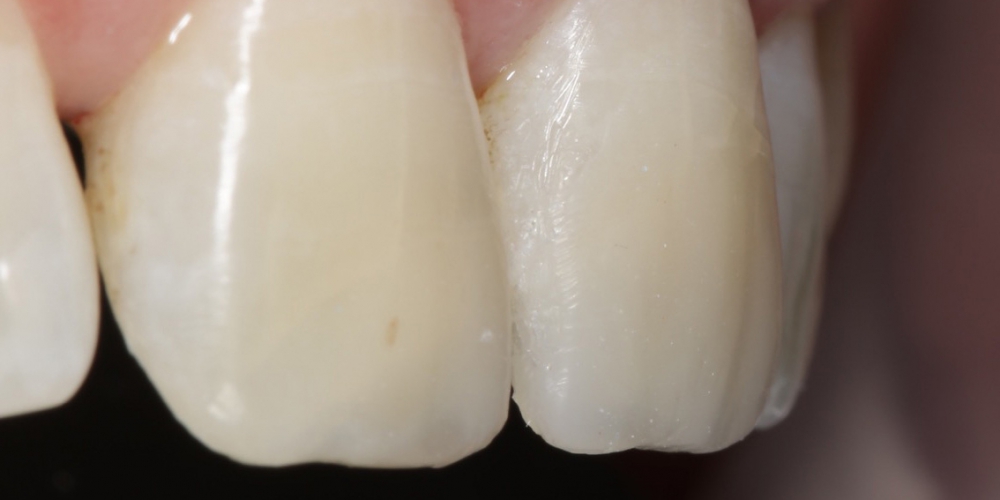  Ремонт скола зуба, ревставрация зубов из композита