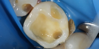 Реставрация жевательного зуба фото до лечения